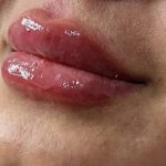 تزریق ژل و بوتاکس در ساری | مزوتراپی و جوانسازی صورت
