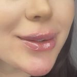 تزریق ژل و بوتاکس در ساری | مزوتراپی و جوانسازی صورت