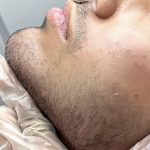 تزریق ژل و بوتاکس در ساری | مزوتراپی و جوانسازی صورت